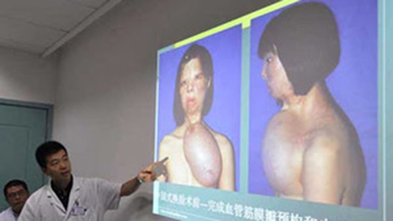 Illustration for article titled Burned Teen Grows New Face Parts on Her Chest (Warning: Graphic)